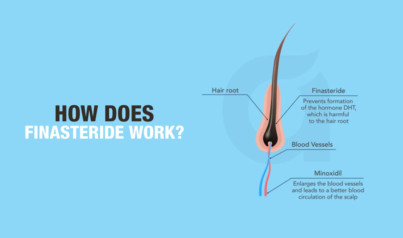 How Does Finasteride Work